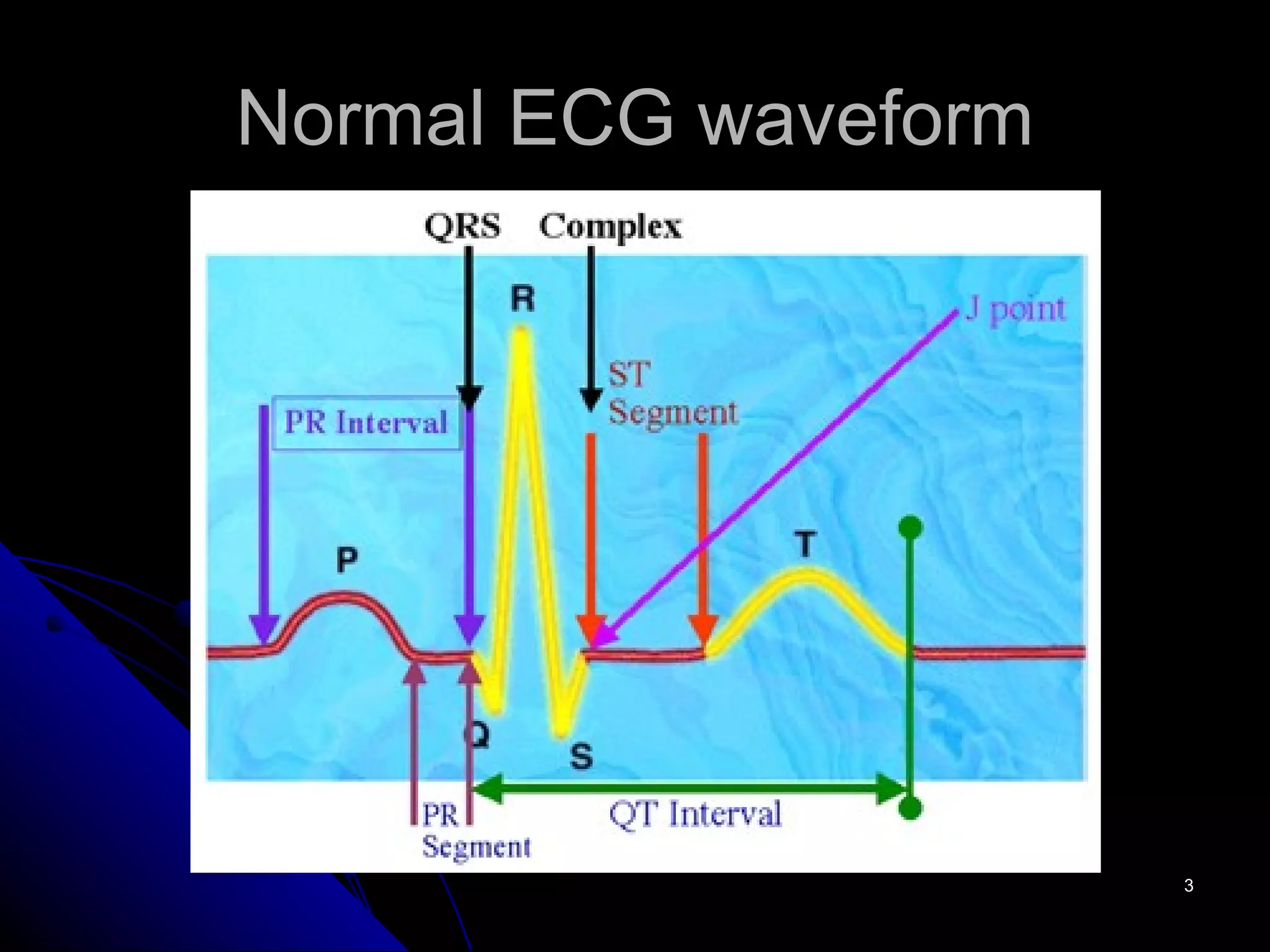 Normal ECG waveform 