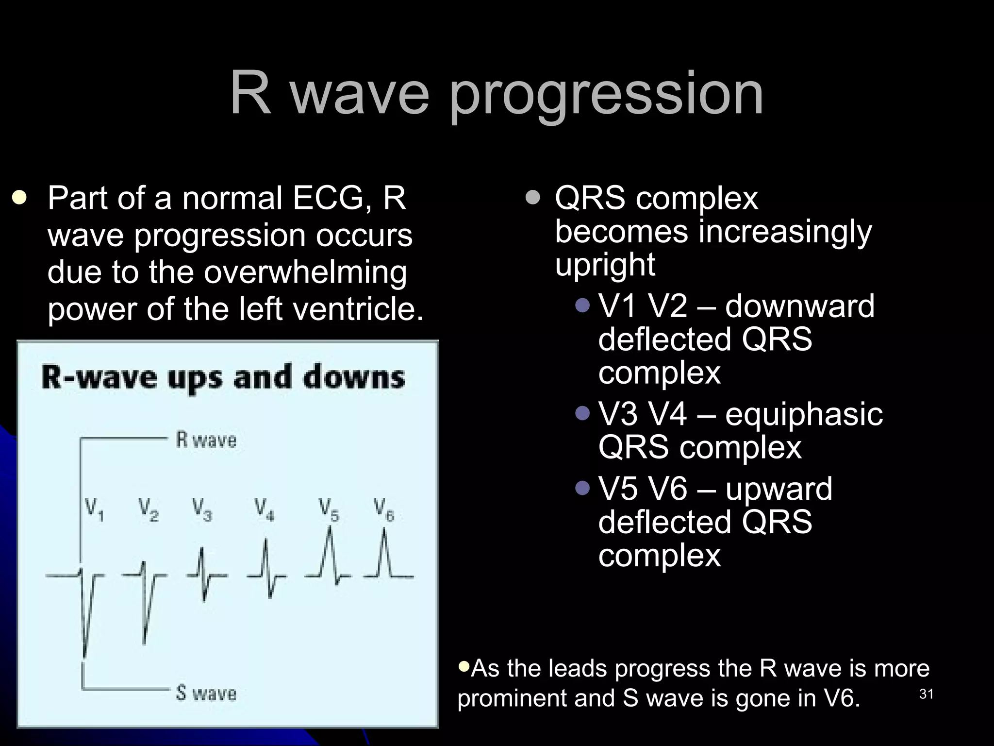 R wave progression Part of a normal ECG, R wave progression occurs due to the overwhelming power of the left ventricle. QRS complex becomes increasingly upright V1 V2 – downward deflected QRS complex V3 V4 – equiphasic QRS complex V5 V6 – upward deflected QRS complex As the leads progress the R wave is more prominent and S wave is gone in V6.  