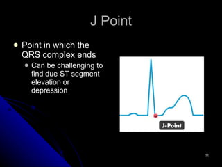 J Point Point in which the QRS complex ends Can be challenging to find due ST segment elevation or depression 