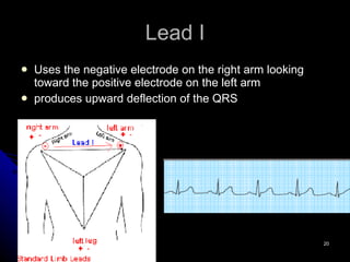 Lead I Uses the negative electrode on the right arm looking toward the positive electrode on the left arm  produces upward deflection of the QRS 