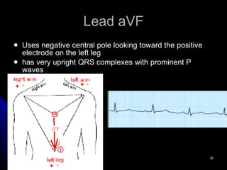 Lead aVF Uses negative central pole looking toward the positive electrode on the left leg has very upright QRS complexes with prominent P waves 