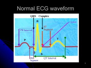 Normal ECG waveform 