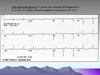 12 lead ecg | PPT