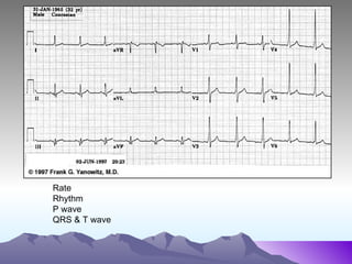 12 lead ecg | PPT