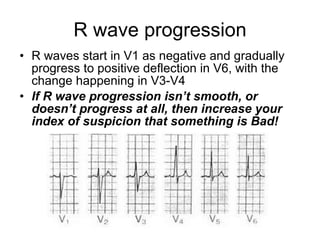 R wave progression R waves start in V1 as negative and gradually progress to positive deflection in V6, with the change happening in V3-V4 If R wave progression isn’t smooth, or doesn’t progress at all, then increase your index of suspicion that something is Bad! 