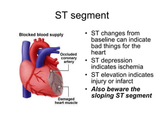 ST segment ST changes from baseline can indicate bad things for the heart ST depression indicates ischemia ST elevation indicates injury or infarct Also beware the sloping ST segment 