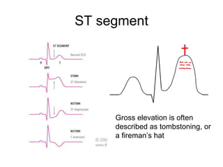 ST segment Gross elevation is often described as tombstoning, or a fireman’s hat 