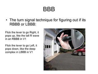 BBB The turn signal technique for figuring out if its RBBB or LBBB: Flick the lever to go Right, it pops up, like the tall R wave in an RBBB in V1 Flick the lever to go Left, it pops down, like the deep complex in LBBB in V1 