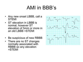AMI in BBB’s Any new onset LBBB, call a STEMI ST elevation in LBBB is normal, however ST elevation of 5mm or more in an old LBBB =STEMI Be suspicious of new RBBB There are no ST changes normally associated with RBBB so any elevation =STEMI 
