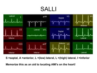 SALLI S =septal, A =anterior, L =(low) lateral, L =(high) lateral, I =inferior Memorize this as an aid to locating AMI’s on the heart! 