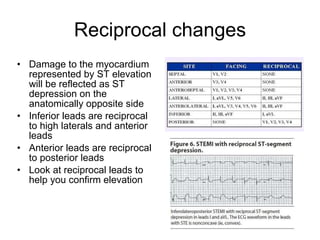 Reciprocal changes Damage to the myocardium represented by ST elevation will be reflected as ST depression on the anatomically opposite side Inferior leads are reciprocal to high laterals and anterior leads Anterior leads are reciprocal to posterior leads Look at reciprocal leads to help you confirm elevation 