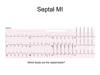 Septal MI Which leads are the septal leads? 