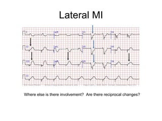 Lateral MI Where else is there involvement?  Are there reciprocal changes? 