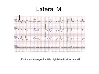 Lateral MI Reciprocal changes? Is this high lateral or low lateral? 