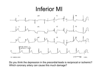 Inferior MI Do you think the depression in the precordial leads is reciprocal or ischemic? Which coronary artery can cause this much damage? 
