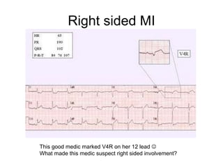 Right sided MI This good medic marked V4R on her 12 lead     What made this medic suspect right sided involvement? 