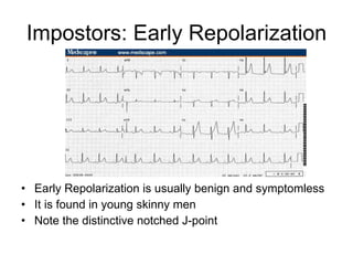 Impostors: Early Repolarization Early Repolarization is usually benign and symptomless It is found in young skinny men Note the distinctive notched J-point 