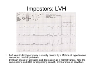 Impostors: LVH Left Ventricular Hypertrophy is usually caused by a lifetime of hypertension, so suspect cardiac problems LVH can cause ST elevation and depression as a normal variant.  Use the same criteria as LBBB for diagnosing an AMI, 5mm or more of elevation. 