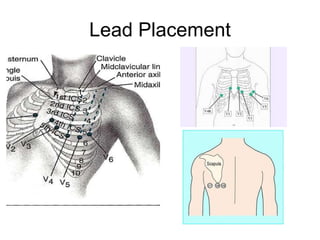 Lead Placement 