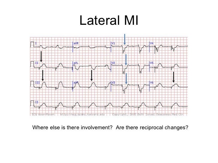 12 lead ecg 35 728