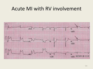 Acute MI with RV involvement
101
 