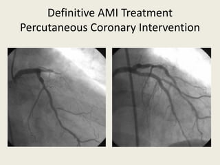 Definitive AMI Treatment
Percutaneous Coronary Intervention
 