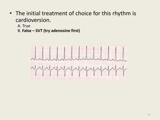 • The initial treatment of choice for this rhythm is
cardioversion.
A. True
B. False – SVT (try adenosine first)
11
 