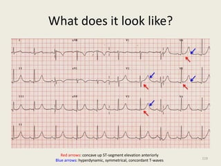 What does it look like?
Red arrows: concave up ST-segment elevation anteriorly
Blue arrows: hyperdynamic, symmetrical, concordant T-waves 119
 