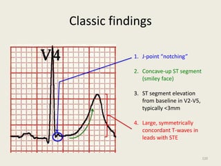 Classic findings
1. J-point “notching”
2. Concave-up ST segment
(smiley face)
3. ST segment elevation
from baseline in V2-V5,
typically <3mm
4. Large, symmetrically
concordant T-waves in
leads with STE
120
 