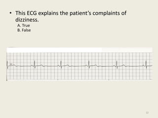• This ECG explains the patient’s complaints of
dizziness.
A. True
B. False
12
 