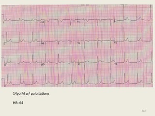 14yo M w/ palpitations
HR: 64
122
 