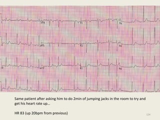 Same patient after asking him to do 2min of jumping jacks in the room to try and
get his heart rate up…
HR 83 (up 20bpm from previous) 124
 