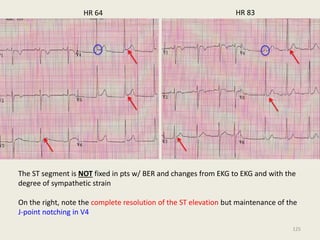 HR 64 HR 83
The ST segment is NOT fixed in pts w/ BER and changes from EKG to EKG and with the
degree of sympathetic strain
On the right, note the complete resolution of the ST elevation but maintenance of the
J-point notching in V4
125
 