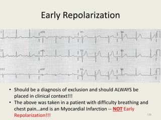 Early Repolarization
• Should be a diagnosis of exclusion and should ALWAYS be
placed in clinical context!!!
• The above was taken in a patient with difficulty breathing and
chest pain…and is an Myocardial Infarction -- NOT Early
Repolarization!!! 126
 