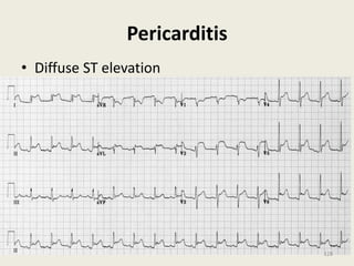 Pericarditis
• Diffuse ST elevation
128
 