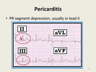 Pericarditis
• PR segment depression, usually in lead II
129
 