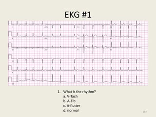 EKG #1
1. What is the rhythm?
a. V-Tach
b. A-Fib
c. A-flutter
d. normal 133
 