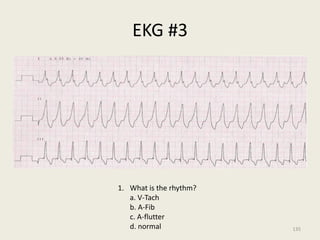 EKG #3
1. What is the rhythm?
a. V-Tach
b. A-Fib
c. A-flutter
d. normal 135
 