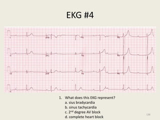 EKG #4
1. What does this EKG represent?
a. sius bradycardia
b. sinus tachycardia
c. 2nd degree AV block
d. complete heart block
136
 