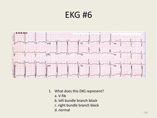 EKG #6
1. What does this EKG represent?
a. V-fib
b. left bundle branch block
c. right bundle branch block
d. normal
138
 