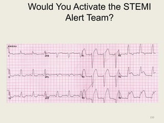 Would You Activate the STEMI
Alert Team?
150
 