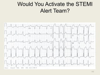 Would You Activate the STEMI
Alert Team?
152
 
