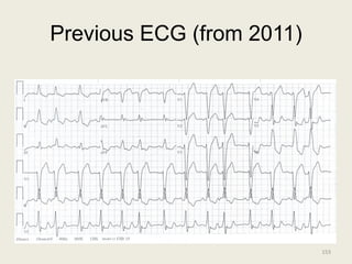 Previous ECG (from 2011)
153
 