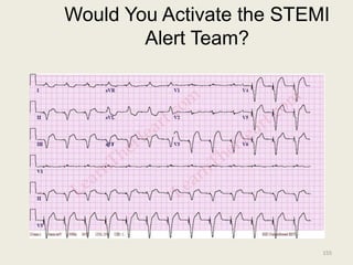 Would You Activate the STEMI
Alert Team?
155
 