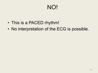 NO!
• This is a PACED rhythm!
• No interpretation of the ECG is possible.
156
 