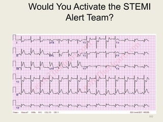 Would You Activate the STEMI
Alert Team?
162
 