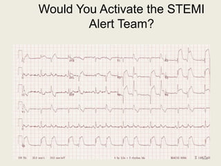 Would You Activate the STEMI
Alert Team?
166
 
