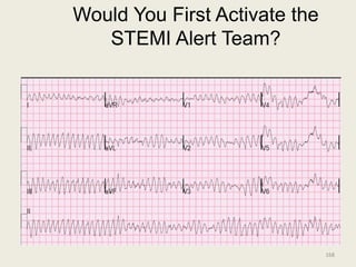Would You First Activate the
STEMI Alert Team?
168
 