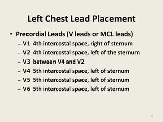 Left Chest Lead Placement
• Precordial Leads (V leads or MCL leads)
– V1 4th intercostal space, right of sternum
– V2 4th intercostal space, left of the sternum
– V3 between V4 and V2
– V4 5th intercostal space, left of sternum
– V5 5th intercostal space, left of sternum
– V6 5th intercostal space, left of sternum
22
 