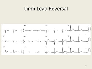 Limb Lead Reversal
26
 
